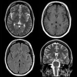 Featured image is from January 2, 2018 — “Information from brain magnetic resonance images (MRIs) can help identify people with attention deficit hyperactivity disorder (ADHD) and distinguish among subtypes of the condition, according to a study appearing online in the journal Radiology.”