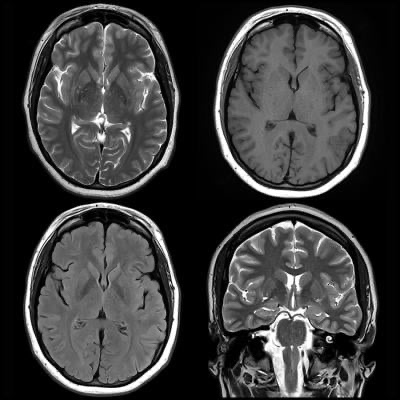 Featured image is from January 2, 2018 — “Information from brain magnetic resonance images (MRIs) can help identify people with attention deficit hyperactivity disorder (ADHD) and distinguish among subtypes of the condition, according to a study appearing online in the journal Radiology.”